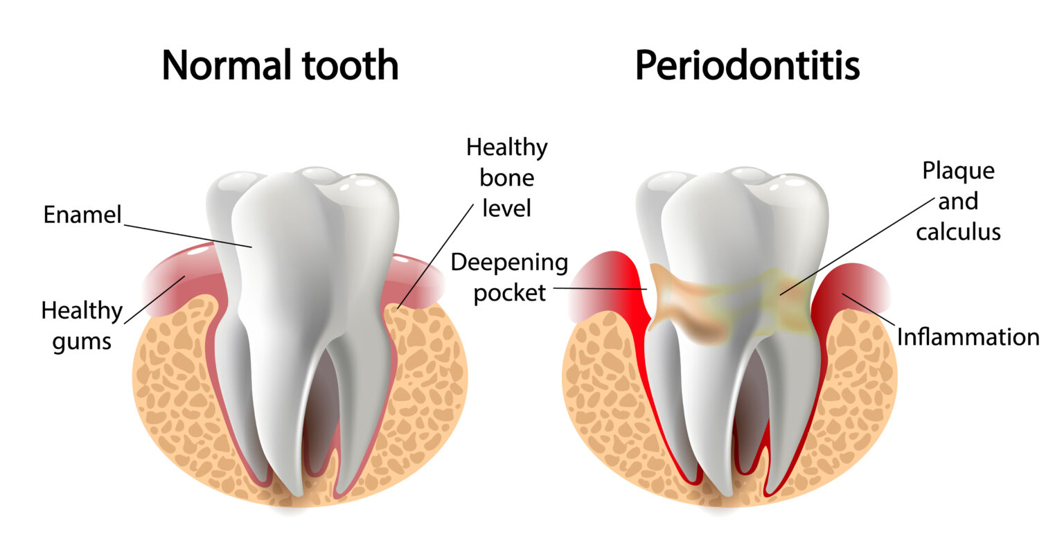 periodontal treatment in okanagan falls